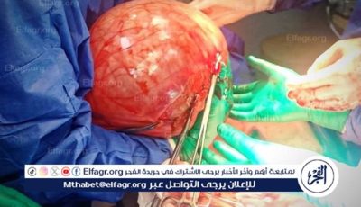 استئصال ورم ضخم يزن أكثر من 15 كجم لفتاة عشرينية
