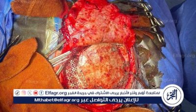 نجاح جراحة دقيقة لزرع عظام الجمجمة بمستشفى السنبلاوين